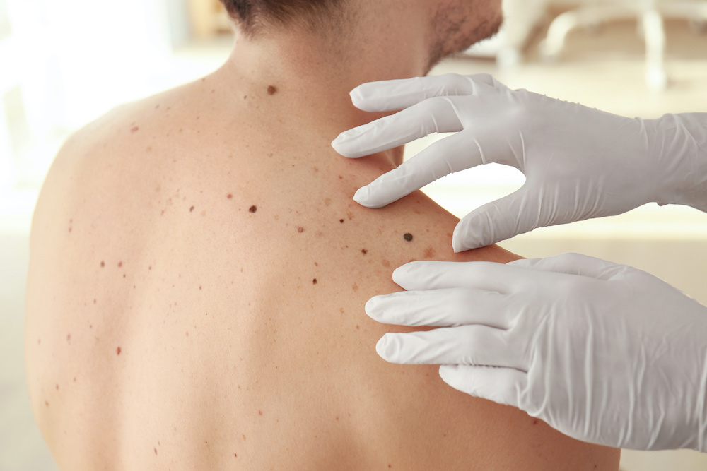 doctor examining patients back of freckles